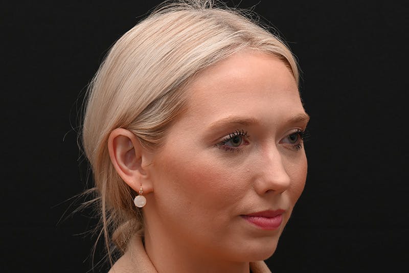 Rhinoplasty Before & After Gallery - Patient 157160 - Image 5