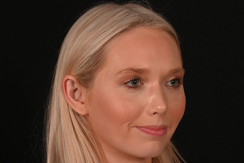 Rhinoplasty Before & After Gallery - Patient 157160 - Image 6