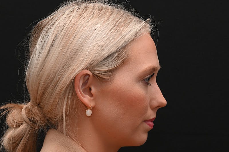 Rhinoplasty Before & After Gallery - Patient 157160 - Image 7