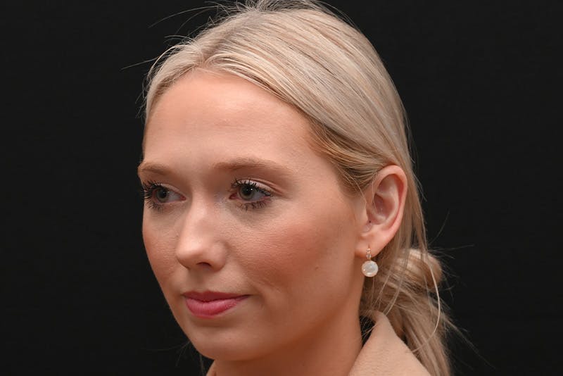 Rhinoplasty Before & After Gallery - Patient 157160 - Image 9
