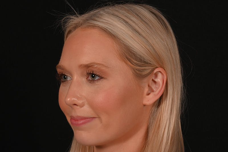 Rhinoplasty Before & After Gallery - Patient 157160 - Image 10