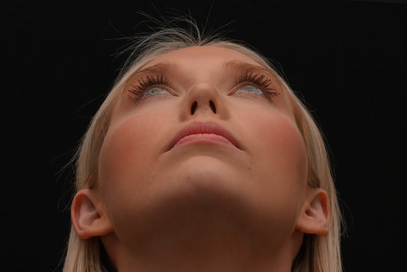 Rhinoplasty Before & After Gallery - Patient 157160 - Image 14