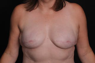 Breast Reconstruction Revision Before & After Gallery - Patient 197593 - Image 2