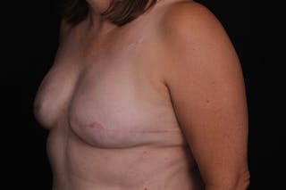 Breast Reconstruction Revision Before & After Gallery - Patient 197593 - Image 4
