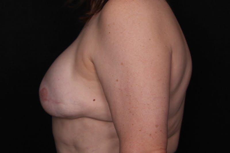Breast Reconstruction Revision Before & After Gallery - Patient 197593 - Image 5