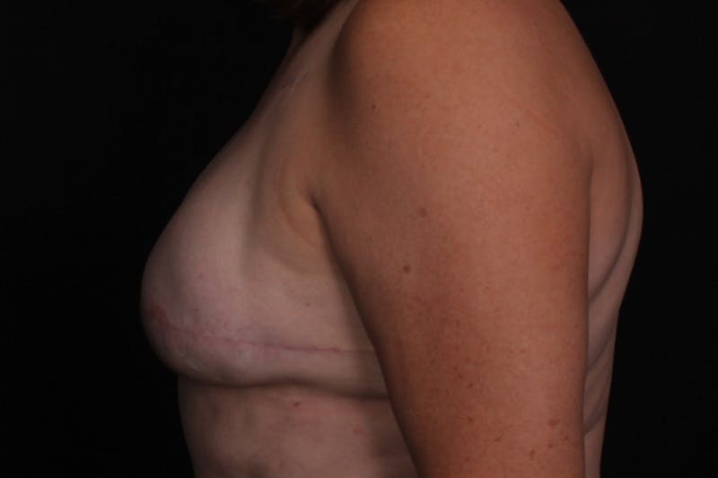 Breast Reconstruction Revision Before & After Gallery - Patient 197593 - Image 6