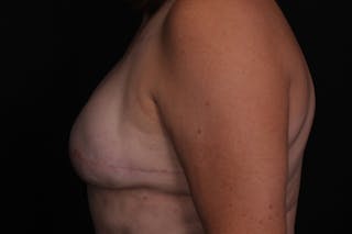 Breast Reconstruction Revision Before & After Gallery - Patient 197593 - Image 6