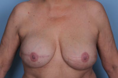 Breast Reconstruction Before & After Gallery - Patient 394004 - Image 2
