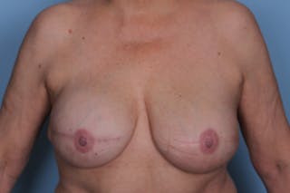Breast Reconstruction Before & After Gallery - Patient 394004 - Image 2