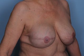 Breast Reconstruction Before & After Gallery - Patient 394004 - Image 4