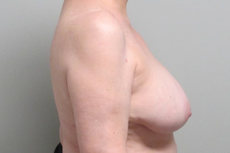 Breast Reconstruction Before & After Gallery - Patient 394004 - Image 5