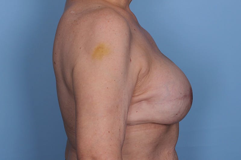 Breast Reconstruction Before & After Gallery - Patient 394004 - Image 6