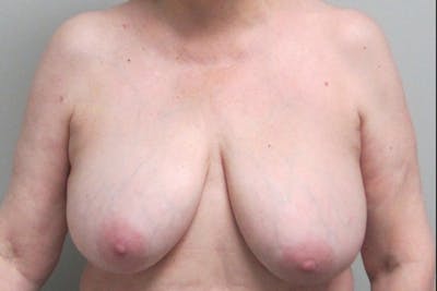 Breast Reconstruction Before & After Gallery - Patient 394004 - Image 1
