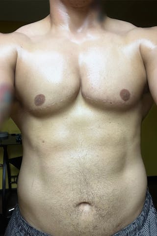 FTM Top Surgery Before & After Gallery - Patient 133639 - Image 4