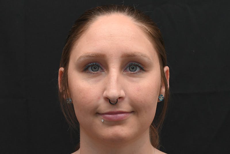 Rhinoplasty Before & After Gallery - Patient 108152 - Image 3