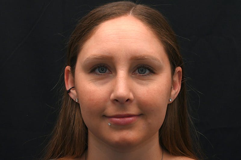 Rhinoplasty Before & After Gallery - Patient 108152 - Image 4