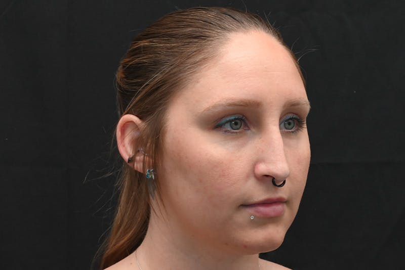 Rhinoplasty Before & After Gallery - Patient 108152 - Image 5