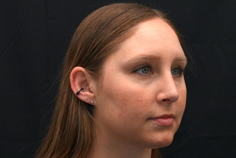 Rhinoplasty Before & After Gallery - Patient 108152 - Image 6