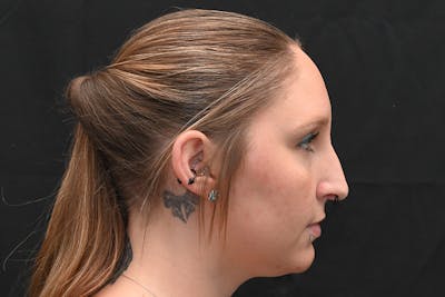 Rhinoplasty Before & After Gallery - Patient 108152 - Image 1