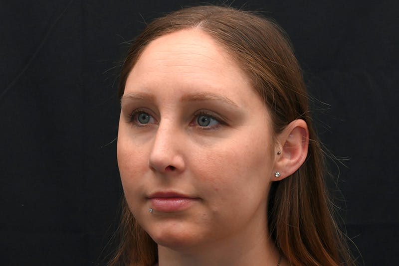 Rhinoplasty Before & After Gallery - Patient 108152 - Image 8