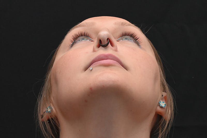 Rhinoplasty Before & After Gallery - Patient 108152 - Image 11