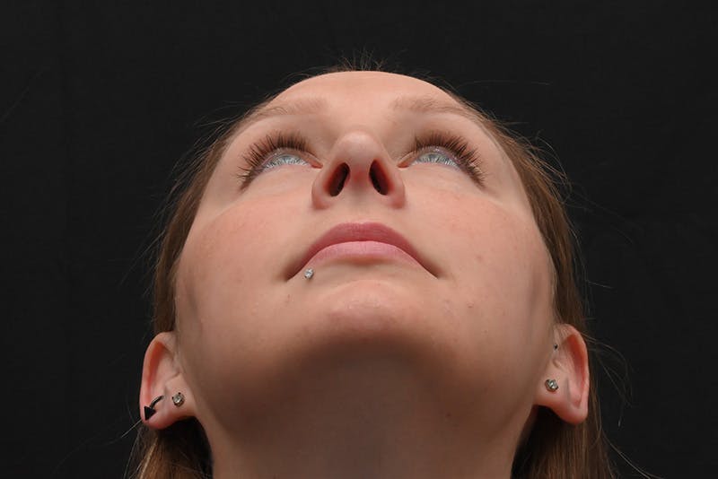 Rhinoplasty Before & After Gallery - Patient 108152 - Image 12