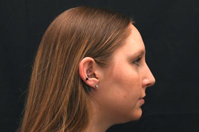 Rhinoplasty Before & After Gallery - Patient 108152 - Image 2