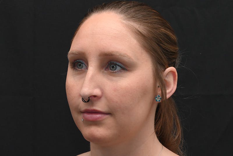 Rhinoplasty Before & After Gallery - Patient 108152 - Image 7