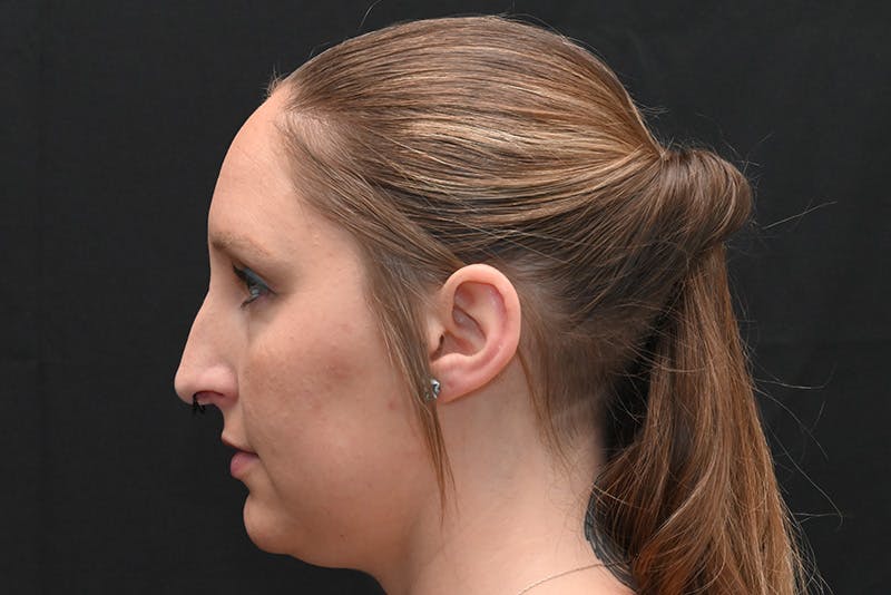 Rhinoplasty Before & After Gallery - Patient 108152 - Image 9