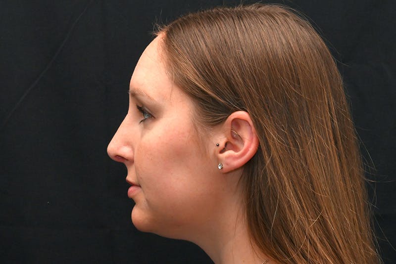 Rhinoplasty Before & After Gallery - Patient 108152 - Image 10