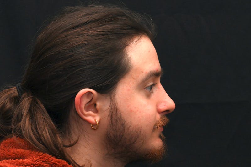 Rhinoplasty Before & After Gallery - Patient 286481 - Image 6