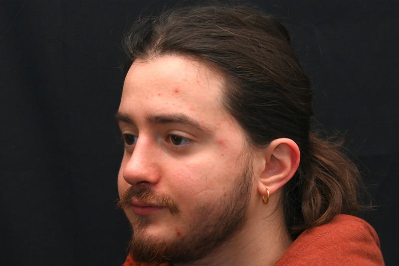 Rhinoplasty Before & After Gallery - Patient 286481 - Image 8
