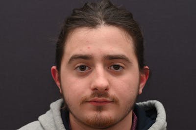 Rhinoplasty Before & After Gallery - Patient 286481 - Image 1