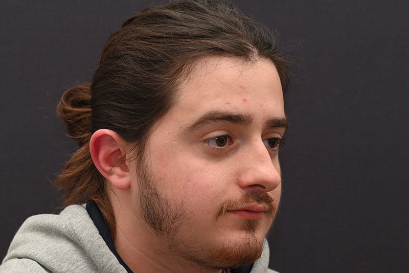 Rhinoplasty Before & After Gallery - Patient 286481 - Image 3