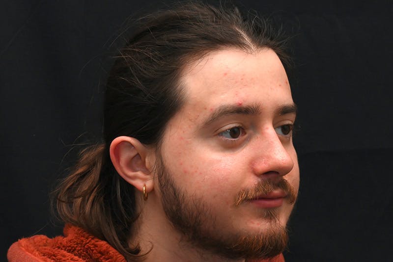 Rhinoplasty Before & After Gallery - Patient 286481 - Image 4