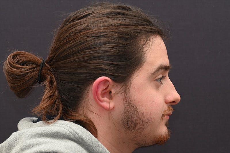 Rhinoplasty Before & After Gallery - Patient 286481 - Image 5