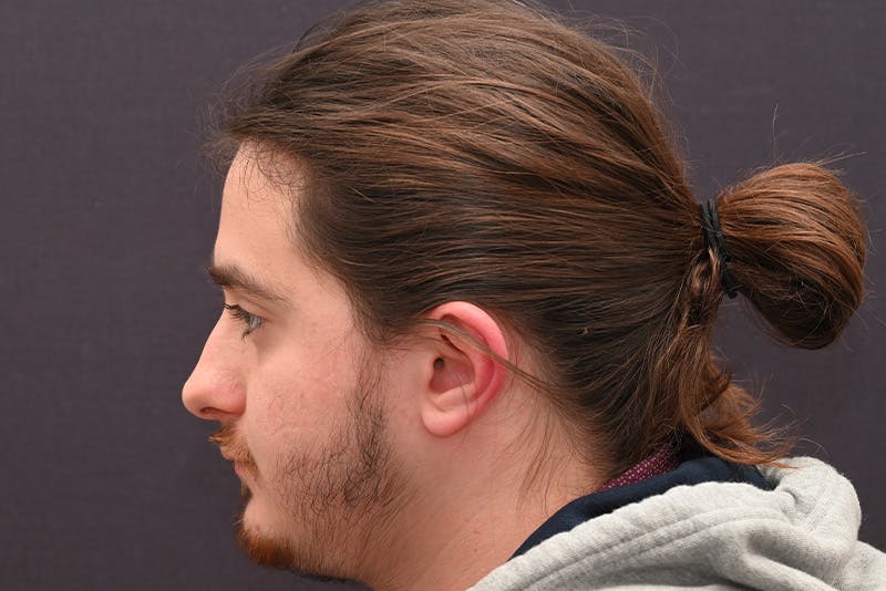 Rhinoplasty Before & After Gallery - Patient 286481 - Image 9