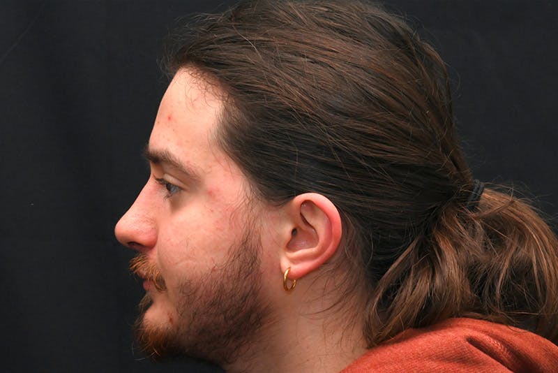Rhinoplasty Before & After Gallery - Patient 286481 - Image 10