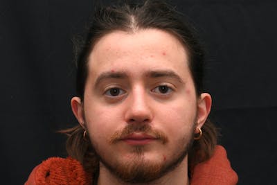 Rhinoplasty Before & After Gallery - Patient 286481 - Image 2
