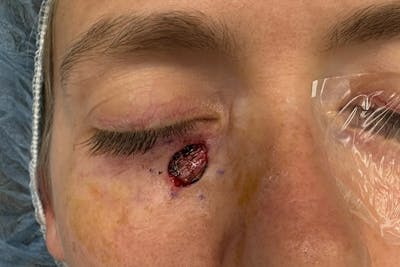 Mohs Facial Reconstruction  Before & After Gallery - Patient 397542 - Image 1