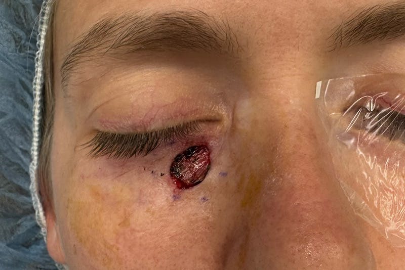 Mohs Facial Reconstruction  Before & After Gallery - Patient 397542 - Image 1