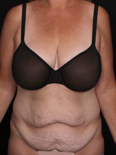 Abdominoplasty Before & After Gallery - Patient 281081 - Image 1