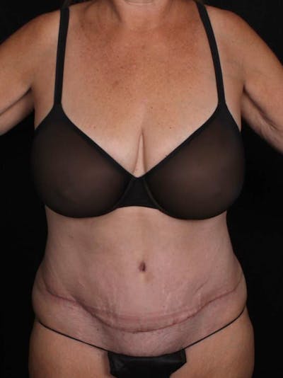 Abdominoplasty Before & After Gallery - Patient 281081 - Image 2