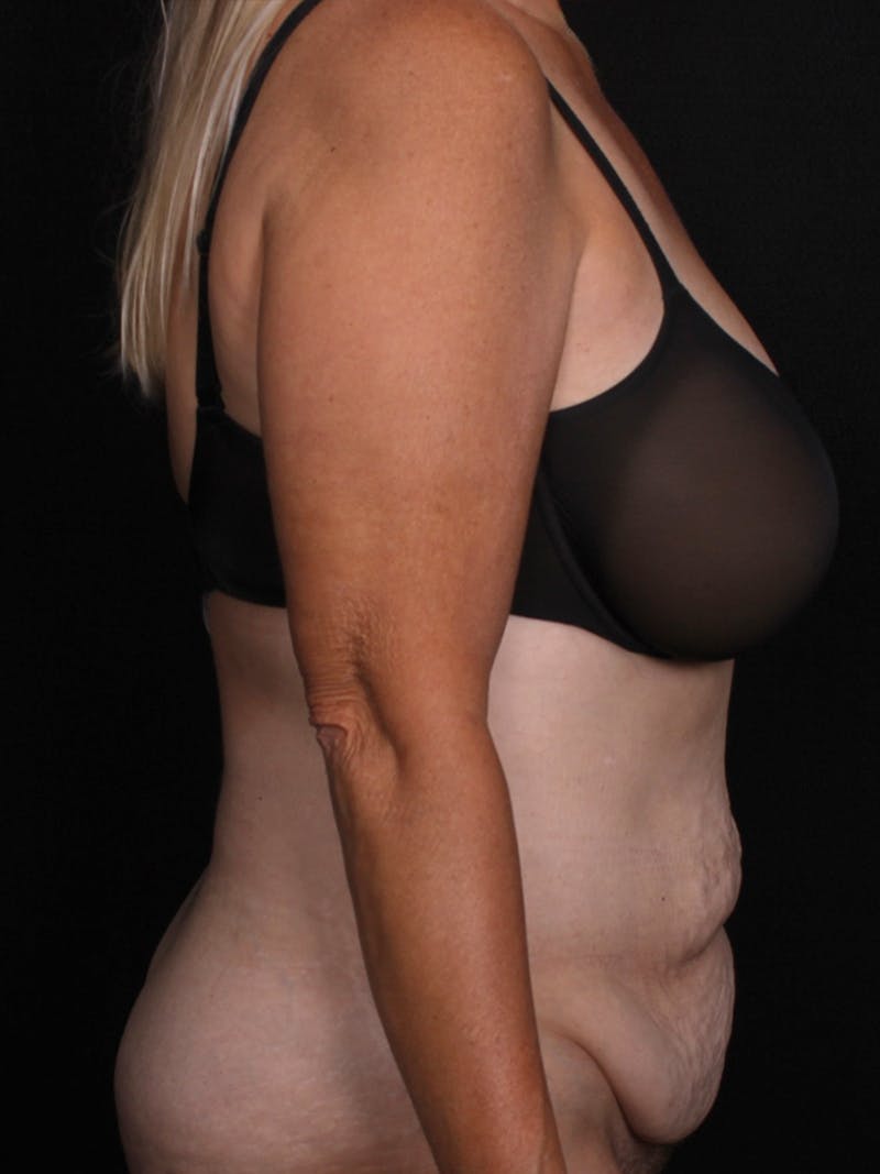 Abdominoplasty Before & After Gallery - Patient 281081 - Image 3
