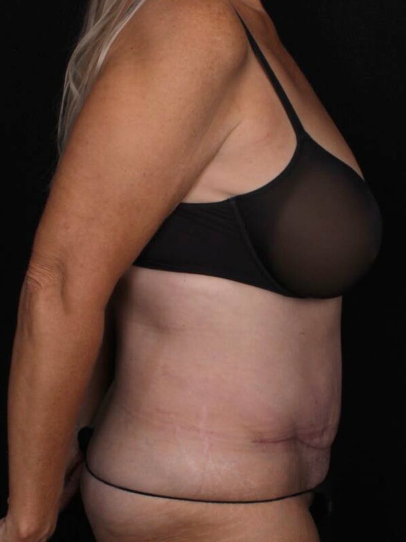 Abdominoplasty Before & After Gallery - Patient 281081 - Image 4