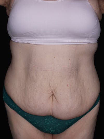 Abdominoplasty Before & After Gallery - Patient 677888 - Image 1