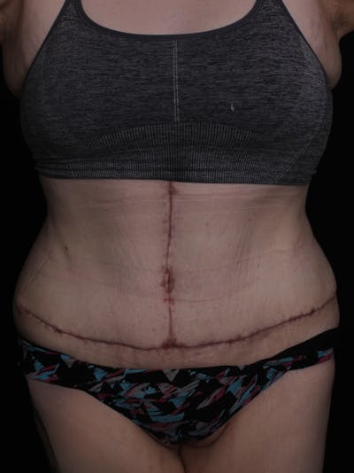 Abdominoplasty Before & After Gallery - Patient 677888 - Image 2