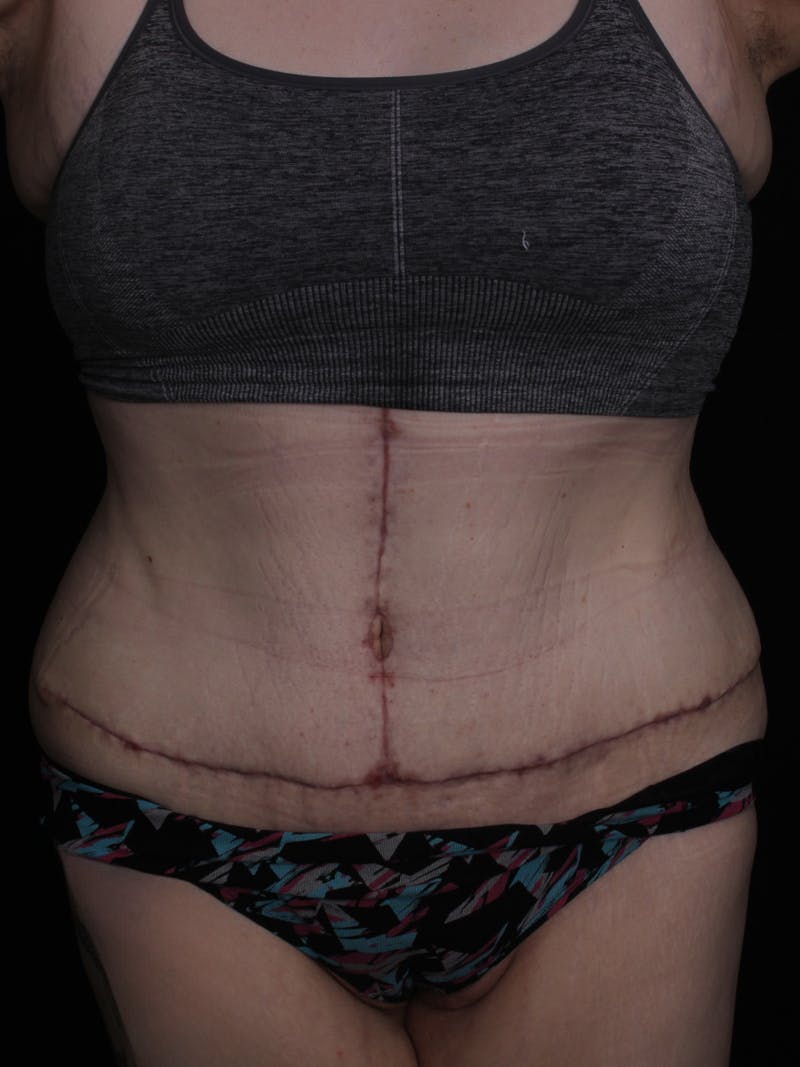 Abdominoplasty Before & After Gallery - Patient 677888 - Image 2