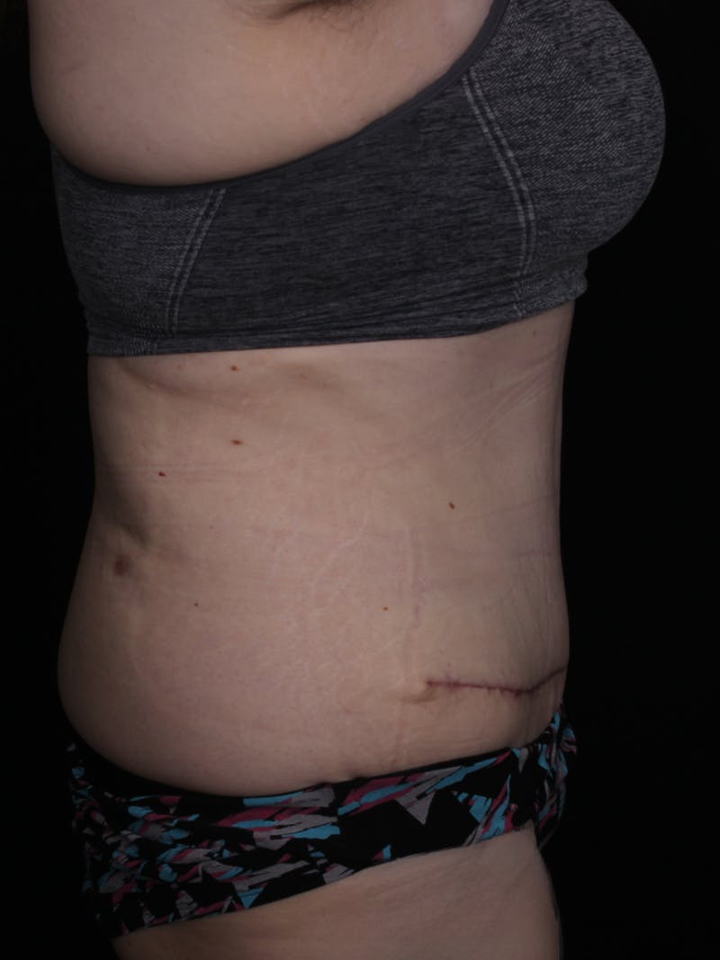 Abdominoplasty Before & After Gallery - Patient 677888 - Image 4