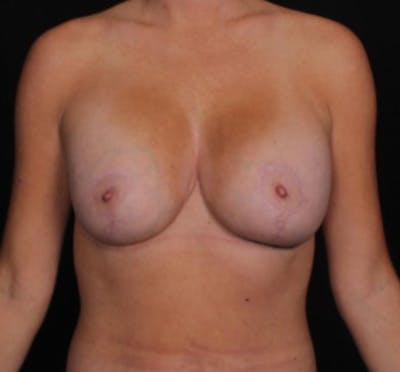 Breast Augmentation with Lift Before & After Gallery - Patient 412009 - Image 2